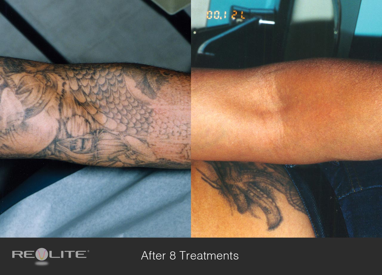 laser tattoo removal