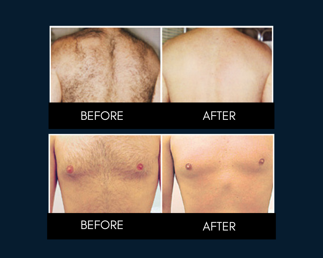 Laser Hair Removal