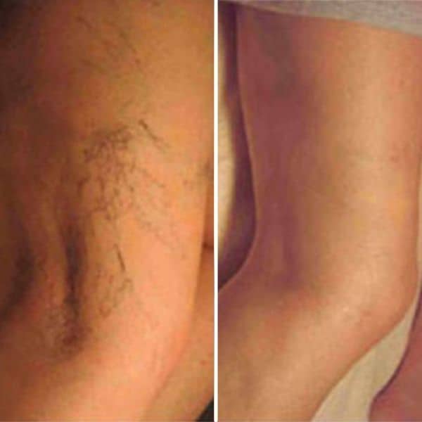 Thread Vein Treatment