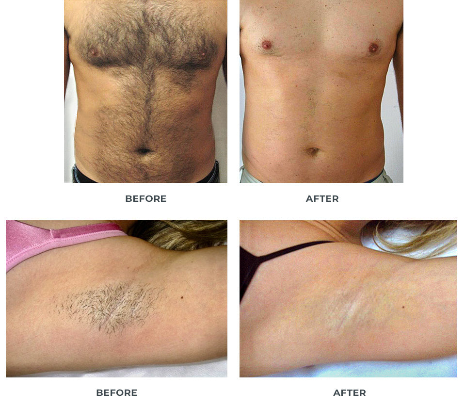 Laser Hair Removal Atlanta