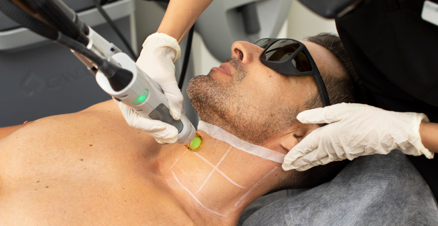 Laser hair removal