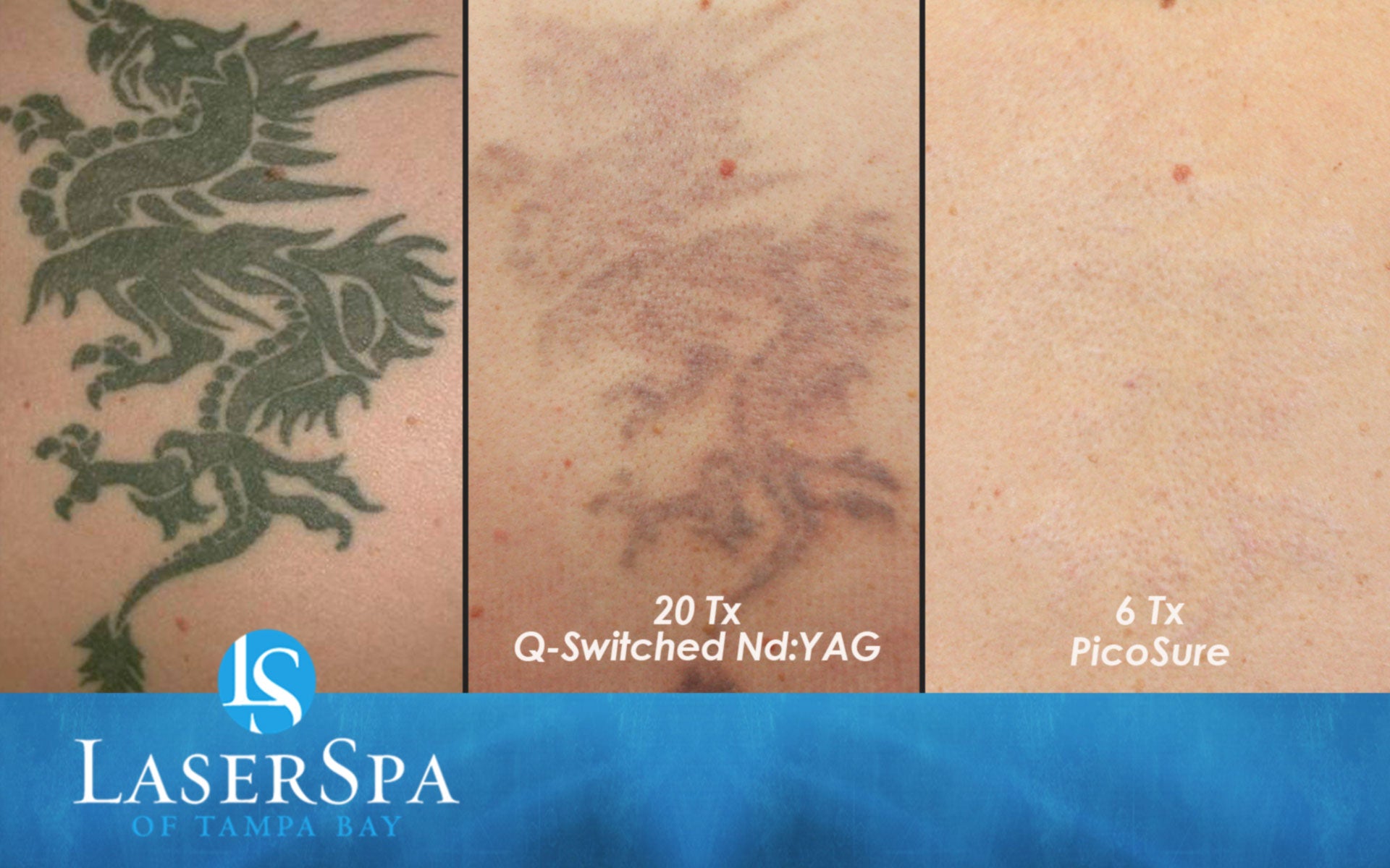 Laser Tattoo Removal LaserSpa of Tampa Bay