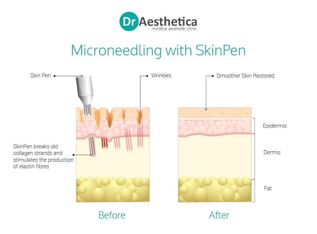 Microneedling at Dr Aesthetica explained