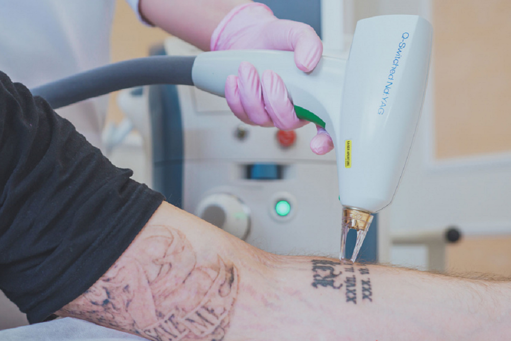 nd yag laser tattoo removal 1