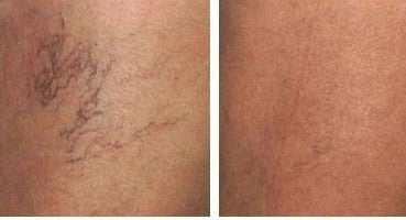 Thread Vein Treatment