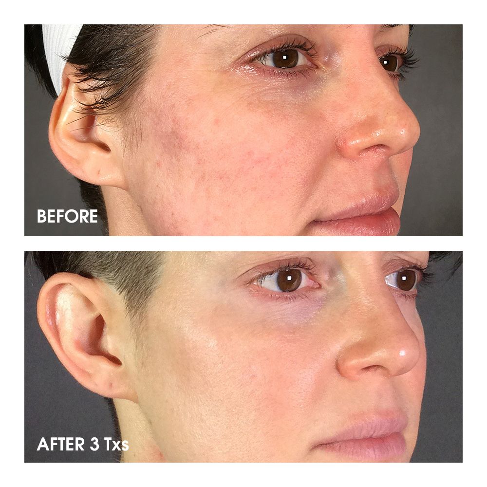 The 9-Second Trick For Microneedling Raleigh Nc