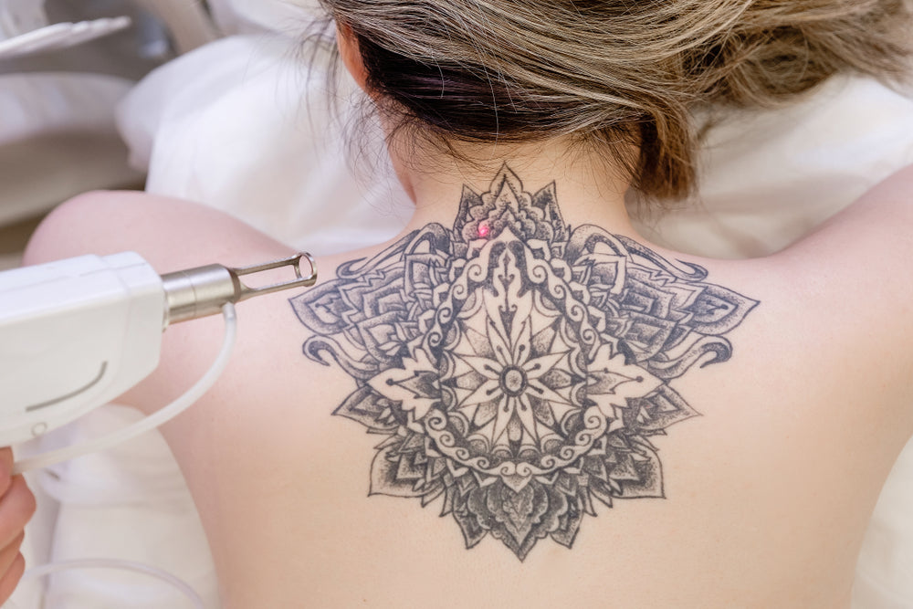 Regret Getting A Tattoo? Here’s Everything You Need to Know About Laser Tattoo Removal