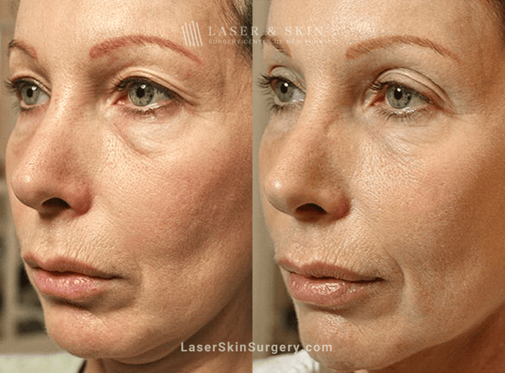 The 2-Minute Rule for Laser Skin Treatments