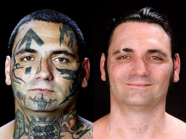 Reformed skinhead Bryon Widner underwent 25 surgeries to remove tattoos on his face, neck, and hands. Credit: AP/CBS News.