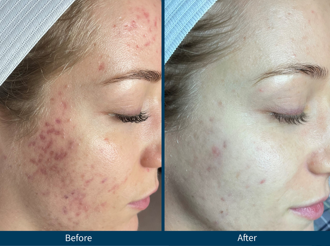 Microneedling Raleigh NC