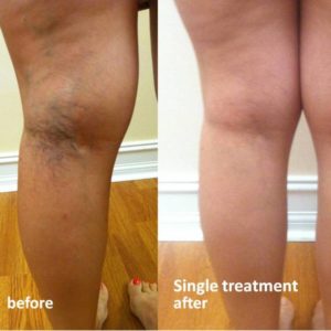 Thread Vein Treatment