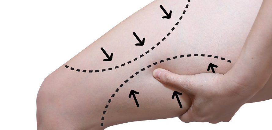 illustration showing the effects of thigh lift