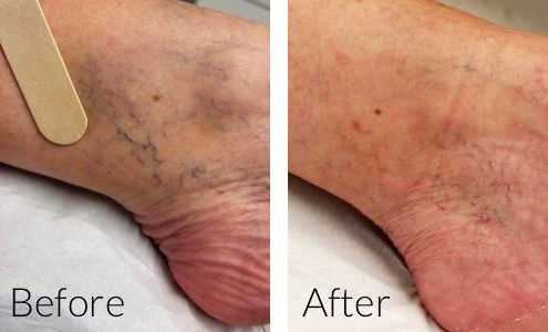 Thread Vein Treatment