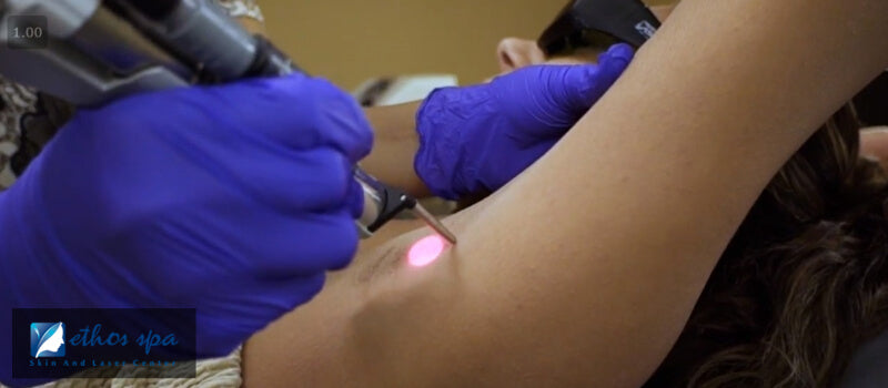 underarm laser hair removal